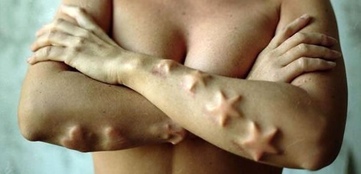 Implantes subcutâneos são feitos a partir da colocação de objetos por debaixo da pele