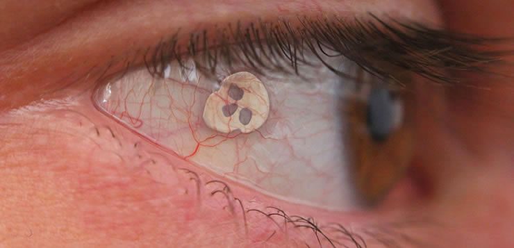 Alguns colocam um implante extraocular por um pequeno corte na camada superficial do olho